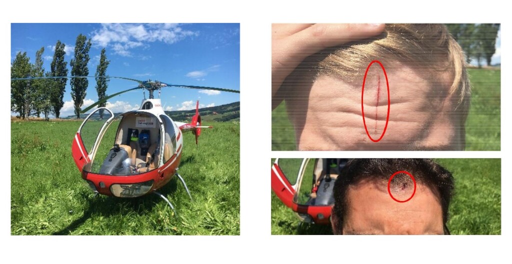Swiss Helicopters Guimbal Cabri G2 HB-ZDQ:  Left, HB-ZDQ helicopter with almost all of the canopy torn off. Right, injuries caused by the impacts of pieces of projected plexiglass (Credit: SUST)